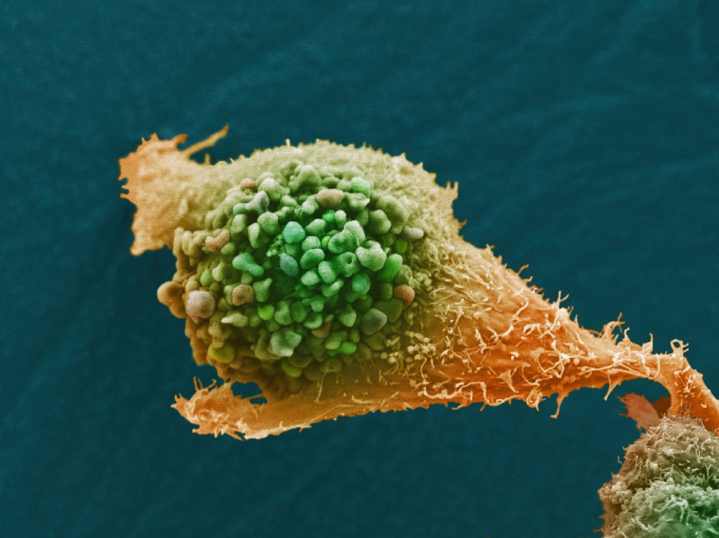 Prostate cancer cell, SEM Anne Weston, Francis Crick Institute