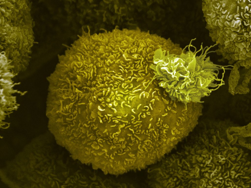 A pancreatic cancer cell. Anne Weston, Francis Crick Institute